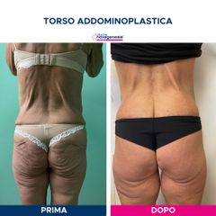 Addominoplastica - Cliniche Novagenesis - dott. Alberto Rossi Todde