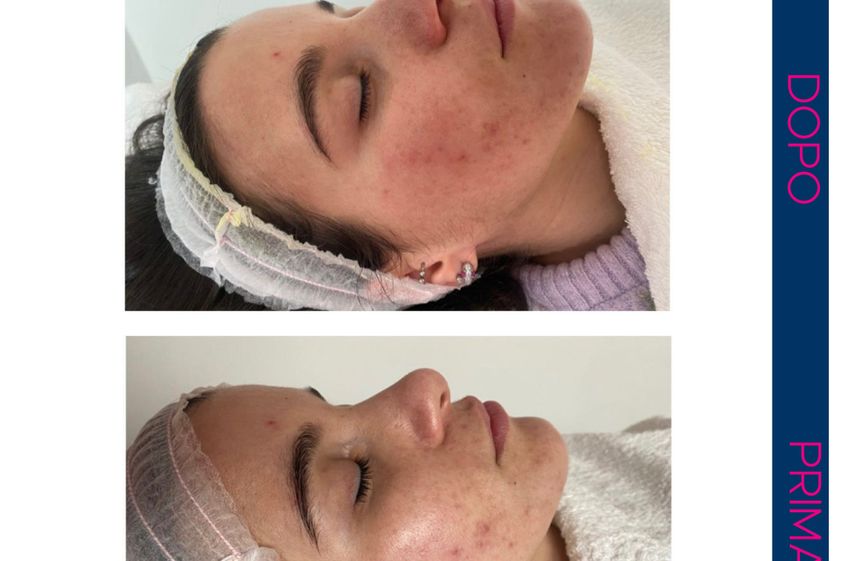 Peeling chimico prima e dopo - 855865