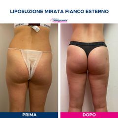Liposuzione - Cliniche Novagenesis - dott. Alberto Rossi Todde