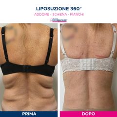 Liposuzione  - Cliniche Novagenesis - dott. Alberto Rossi Todde