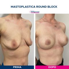 Mastoplastica additiva - Cliniche Novagenesis - dott. Alberto Rossi Todde