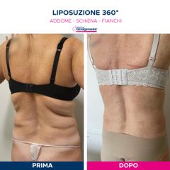 Liposuzione  - Cliniche Novagenesis - dott. Alberto Rossi Todde