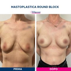 Mastoplastica additiva - Cliniche Novagenesis - dott. Alberto Rossi Todde