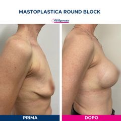 Mastoplastica additiva - Cliniche Novagenesis - dott. Alberto Rossi Todde
