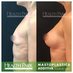 Mastoplastica Nagor prima e dopo