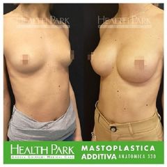 Mastoplastica Anatomica 330 prima e dopo