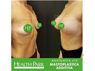 Mastoplastica additiva 410 prima e dopo
