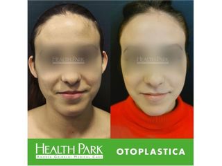 Otoplastica prima e dopo