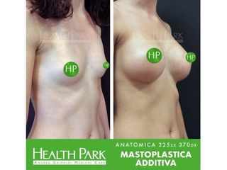Mastoplastica additiva prima e dopo