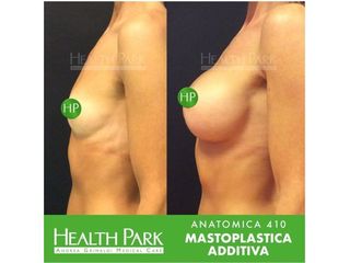 Mastoplastica additiva 410 prima e dopo