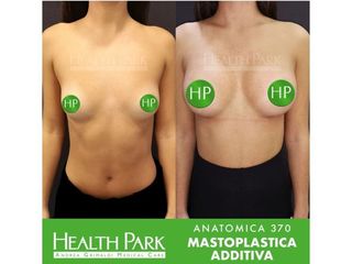 Mastoplastica additiva prima e dopo