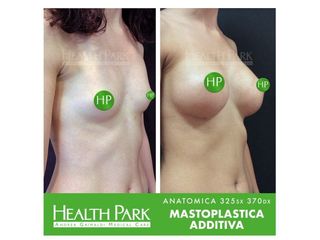 Mastoplastica additiva - Health Park- Andrea Grimaldi Medical Care