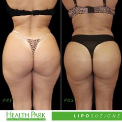 Liposuzione - Health Park- Andrea Grimaldi Medical Care
