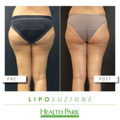 Liposuzione - Health Park- Andrea Grimaldi Medical Care