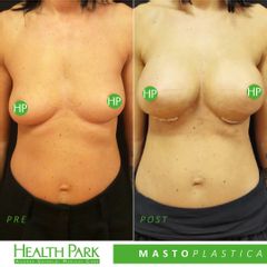 Mastoplastica additiva - Health Park- Andrea Grimaldi Medical Care