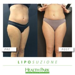 Liposuzione - Health Park- Andrea Grimaldi Medical Care