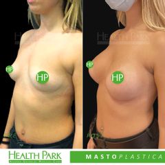Mastoplastica additiva - Health Park- Andrea Grimaldi Medical Care