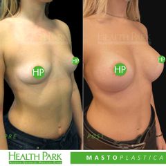 Mastoplastica additiva - Health Park- Andrea Grimaldi Medical Care