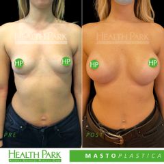 Mastoplastica additiva - Health Park- Andrea Grimaldi Medical Care