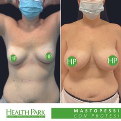 Mastoplastica additiva - Health Park- Andrea Grimaldi Medical Care