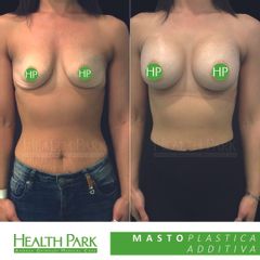 Mastoplastica additiva - Health Park- Andrea Grimaldi Medical Care