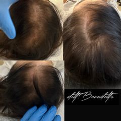 Alopecia - Dott. Michele Benedetto