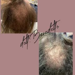 Recupero alopecia - Dott. Michele Benedetto