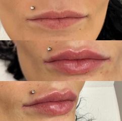 Filler labbra - Dott. Michele Benedetto