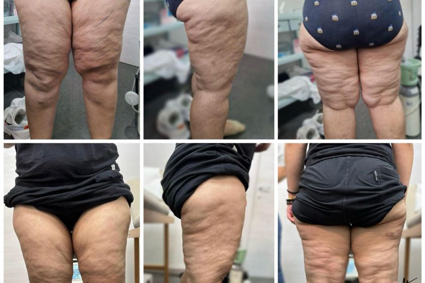Carbossiterapia prima e dopo - 870598