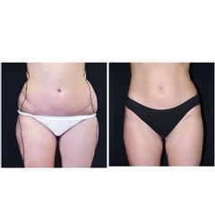 Liposcultura prima e dopo