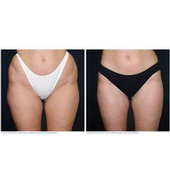 Liposcultura prima e dopo