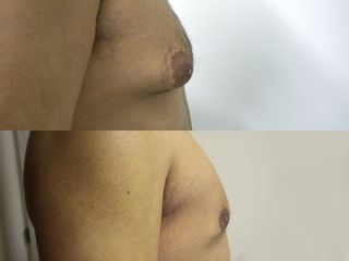 Ginecomastia prima e dopo