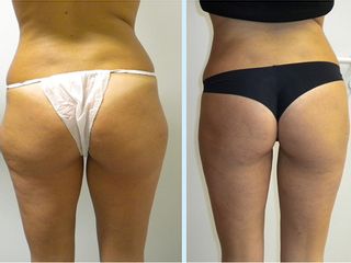 Liposuzione prima e dopo