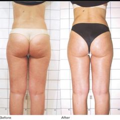 Liposuzione - Silvercare Medical Center - Dott. Antonio Romeo