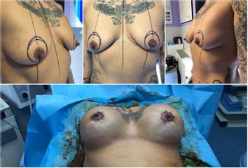Mastoplastica additiva - Silvercare Medical Center - Dott. Antonio Romeo