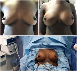 Mastoplastica additiva - Silvercare Medical Center - Dott. Antonio Romeo