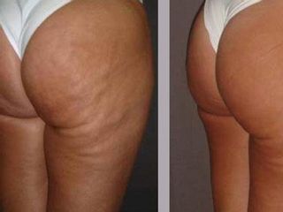 Cellulite prima dopo