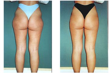 Liposcultura ultrasonica risultato