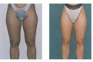 Liposcultura ultrasonica pre e post