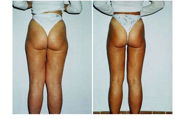 Liposcultura ultrasonica
