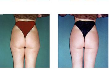 Liposcultura ultrasonica prima e dopo