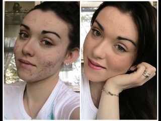 Esiti acne prima e dopo