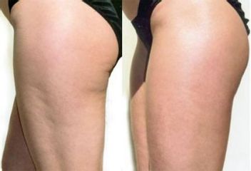 Mesoterapia prima e dopo