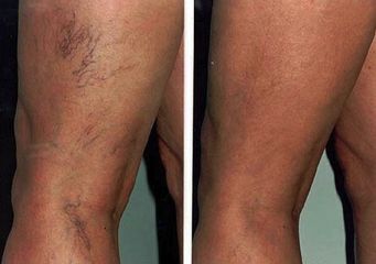 capillari gambe prima e dopo