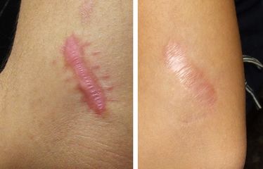 cheloide prima e dopo
