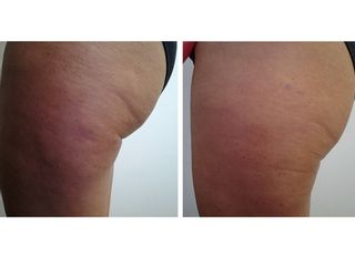 Liposuzione laser prima dopo