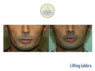 Lifting viso - 304184