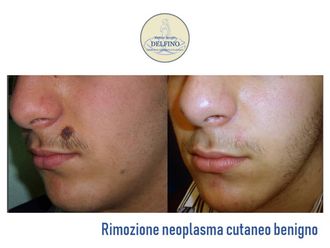 Asportazione nei - 304211