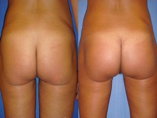 Gluteoplastica prima e dopo