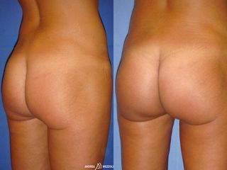 Gluteoplastica prima e dopo